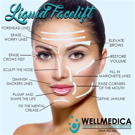 Liquid Facelift At WellMedica Reston Tysons Dima Ali M D