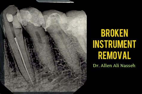 Endodontic Broken Instrument Removal Clinical Case Of Dr Allen Ali Nasseh