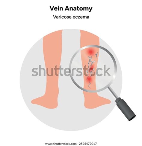 Varicose Veins Venous Anatomy Varicose Eczema Stock Vector Royalty