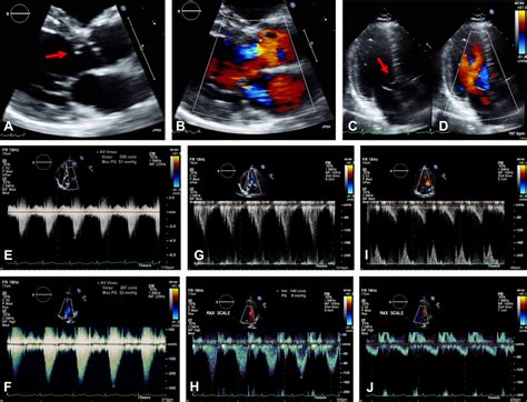 Subaortic Stenosis With Elevated Aortic Gradients In A Pregnant Patient Jacc Case Reports