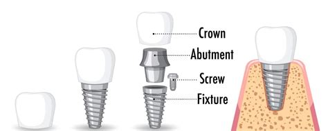 Impianto dentale si muove - Dental Competence Grosseto