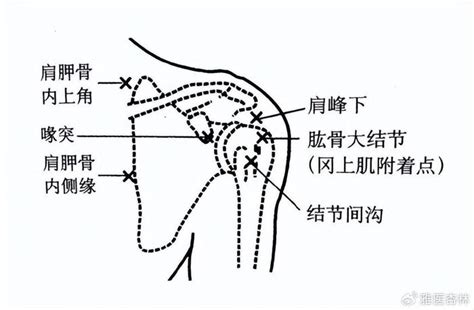 肩周炎——骨科是最常见、最具挑战性的临床疾病之一 肩周炎 肩关节 活动度 新浪新闻