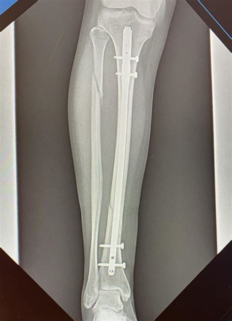 Fractura Combinada De Tibia Y Peron Koena Salud