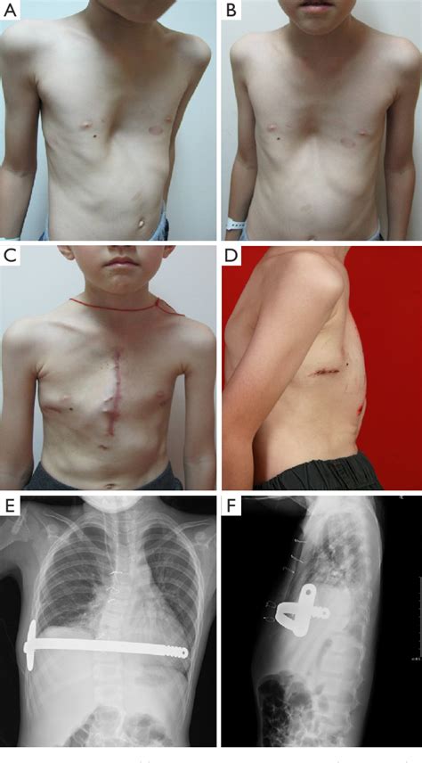 Figure From Surgical Correction Of Pectus Excavatum Cases Via The