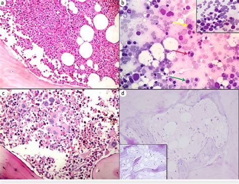 Post Induction Marrow Histomorphological Features A Case Of Aml