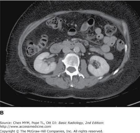 Chapter 9 Radiology Of The Urinary Tract Radiology Key