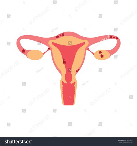 Uterus Endometriosis Flat Illustration Fertility Human Stock Vector Royalty Free 1872605626