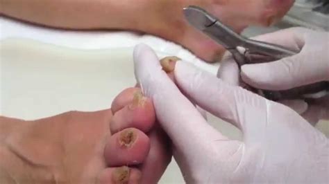 Pedicure How To Remove A Thick And Curled Or Ingrown Toenail Youtube