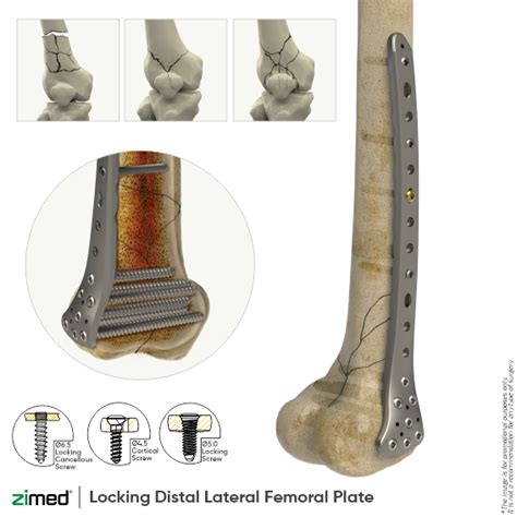 Locking Distal Lateral Femoral Plates Large Fragment Locking Plate