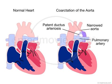 Coarctation of the Aorta – Medmovie.com