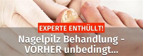 Ratgeber Nagelpilz Wie Behandeln 55 OFF