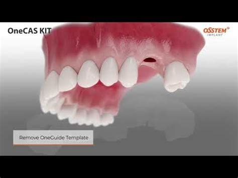 OSSTEM OneCAS KIT OneGuide YouTube