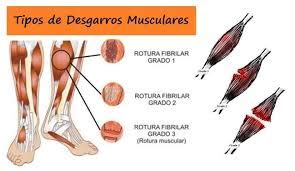 Rotura De Fibras O Desgarro Muscular Tratamiento Ejercicios Y