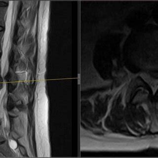 Follow-up MRI scan of the lumbar spine: follow-up MRI scan of the ...