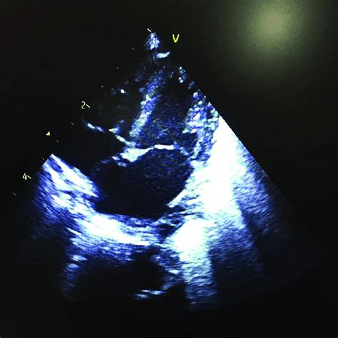 Four Chamber Echocardiographic View Showing Normal Heart Structure