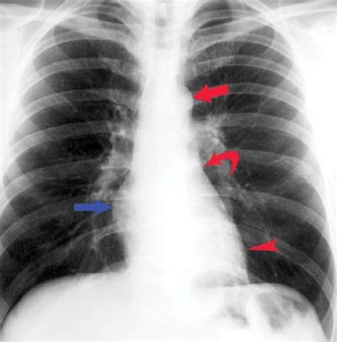 Cardiac Anatomy Physiolgy And Imaging Modalities Radiology Key