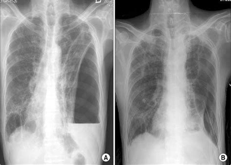 Case 2: Initial chest X-ray shows that large amount of loculated ...