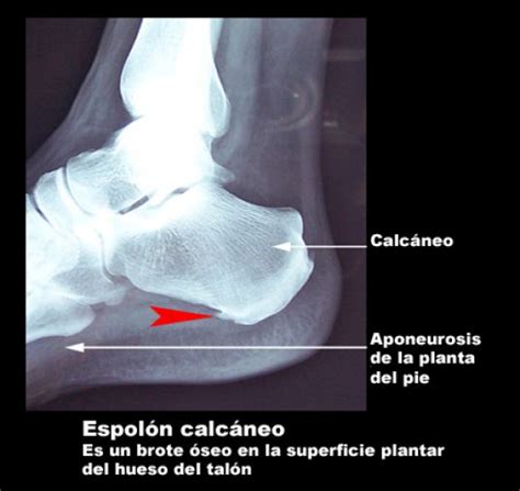 Espol N Calc Neo Terapia Fisica