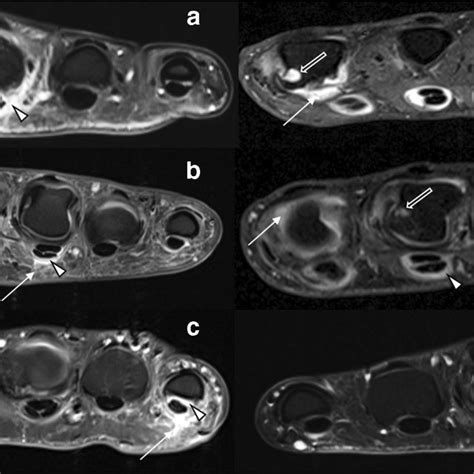 Overview of representative MRI findings in psoriatic arthritis (PsA ...