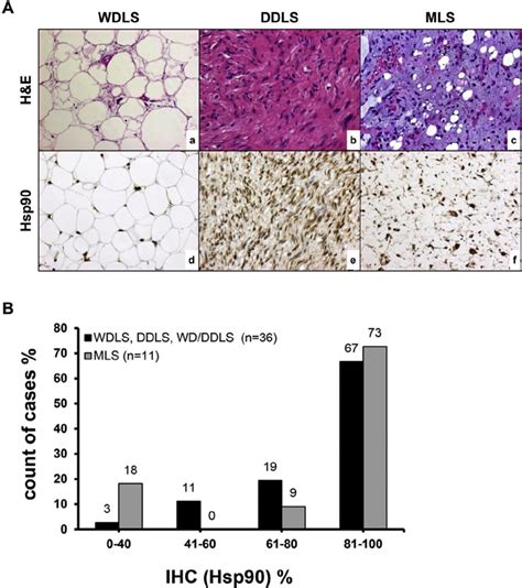 Intermediate To Strong Hsp90 Expression In Human Liposarcoma Tissue