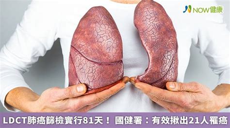 Ldct肺癌篩檢實行81天！ 國健署：有效揪出21人罹癌 Now健康 Line Today