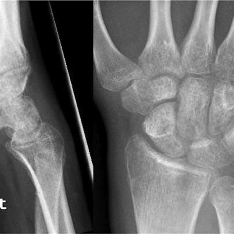 Radiographs of the wrist after Kirschner wires removal. | Download ...