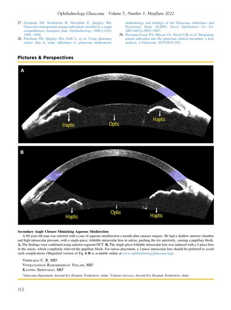 Pdf Secondary Angle Closure Mimicking Aqueous Misdirection