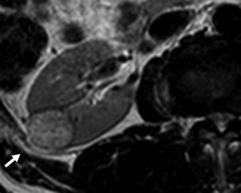 Comparison Of T2 Weighted Mri With And Without Fat Suppression For