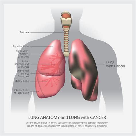 Poumon Avec D Tail Et Illustration Vectorielle De Cancer Du Poumon