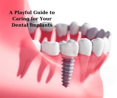 Smile Insurance 101 A Playful Guide To Caring For Your Dental Implants