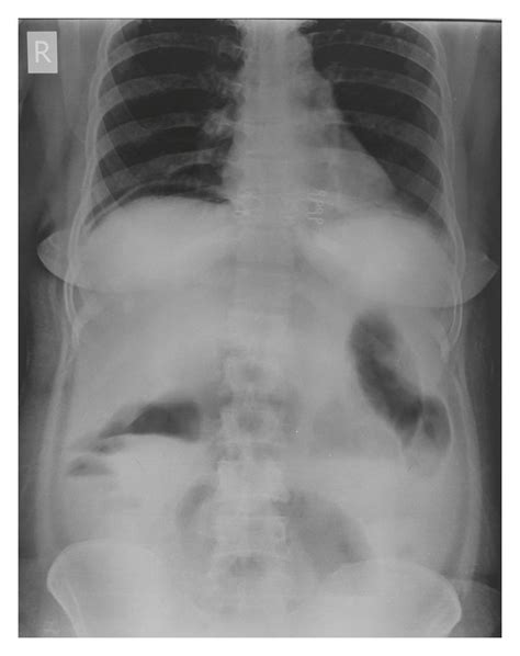 X Ray Abdomen Showing Free Gas Under Right Dome Of Diaphragm Download Scientific Diagram