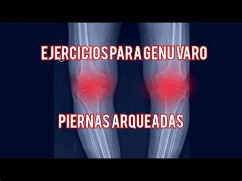 Ejercicios Para GENU VARO O PIERNAS ARQUEADAS YouTube