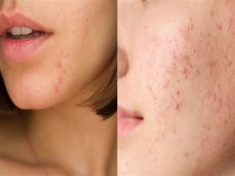 Hormonal Imbalance To Stress Know Which Causes Of Pimples Acne On Face