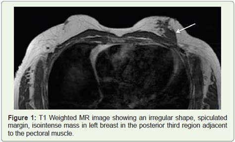 Fibromatosis Of The Male Breast Role Of Dynamic Mri