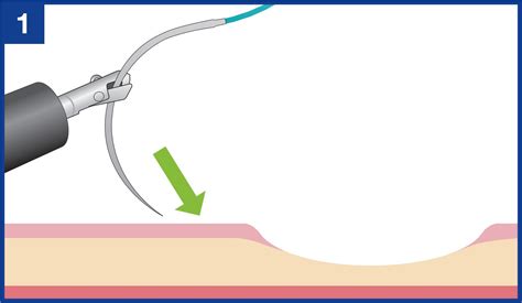 Basic operation and techniques for Endoscopic Hand-Suturing with ...