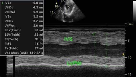 Left ventricular hypertrophy with dysfunction – M-Mode echocardiogram – All About Cardiovascular ...