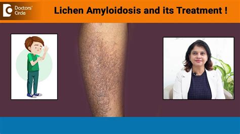 Brownish Red Bumps On Hands Legs Lichen Amyloidosis Its Treatment