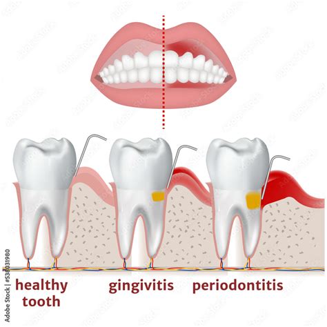 Periodontitis And Gingivitis Diagram With Disease Of Teeth And Gums