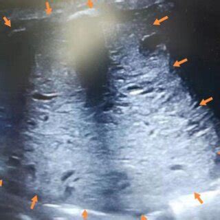 Postnatal ultrasound showing a well-circumscribed, isoechoic mass... | Download Scientific Diagram