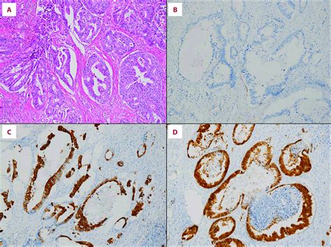 Immunohistological Studies Pathological Finding On Hematoxylin Eosin