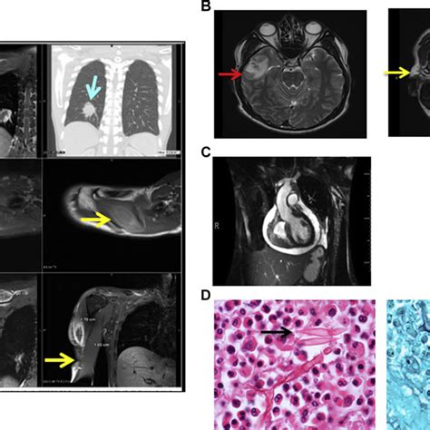 A Chest Magnetic Resonance Imaging Lesions Are Visible In The Right