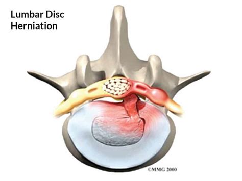 Understanding Lumbar Disc Prolapse And Lumbar Discectomy Spineplus