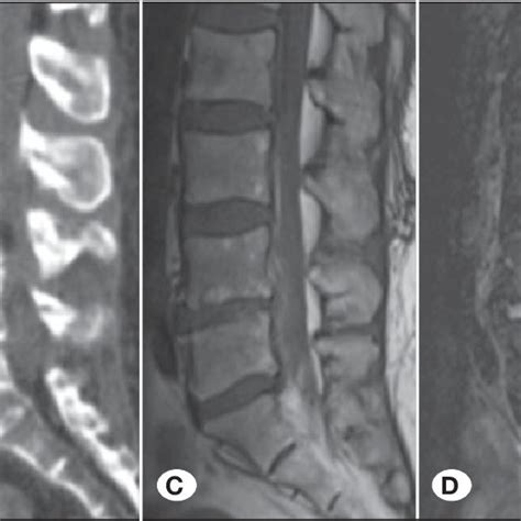 In Stage 1 Sagittal Computed Tomography Ct Scans A B Show Disc