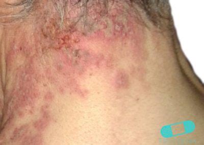 Herpes Zoster Shingles Online Dermatology