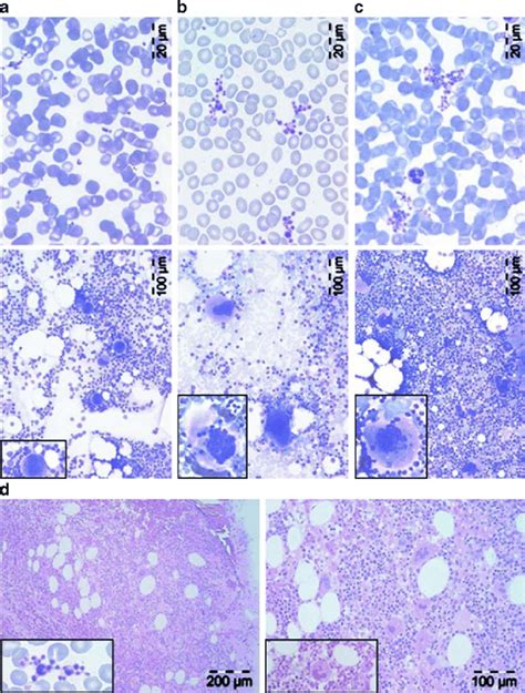 A Presence Of Normal Platelets In A Peripheral Blood Smear And Normal