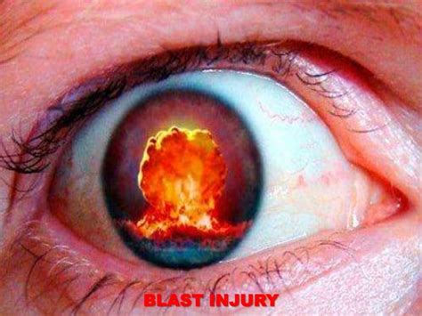 Blast injuries | PPT