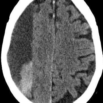 Ct Scan Showing A Large Right Sided Subdural Collection Distorting The