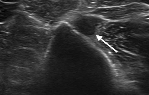 Diagnostic Ultrasound Of The Shoulder Performed At 15 Month Follow Up Download Scientific