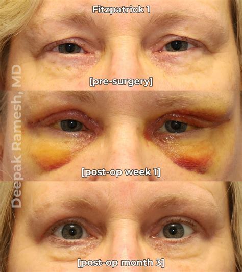 Recovery From Eyelid Surgery New Jersey Dr Deepak Ramesh