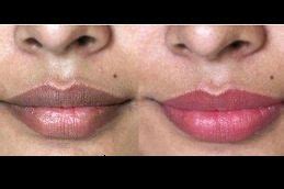 What Can Help Smokers Lips Lipstutorial Org